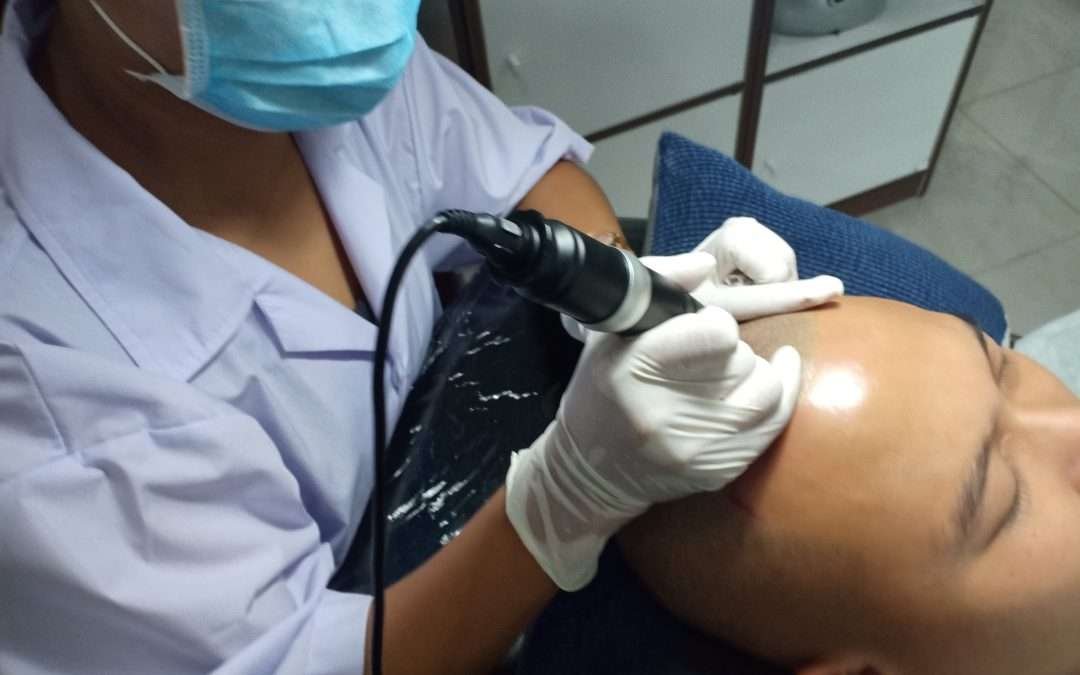 Benefits of Scalp Micro Pigmentation